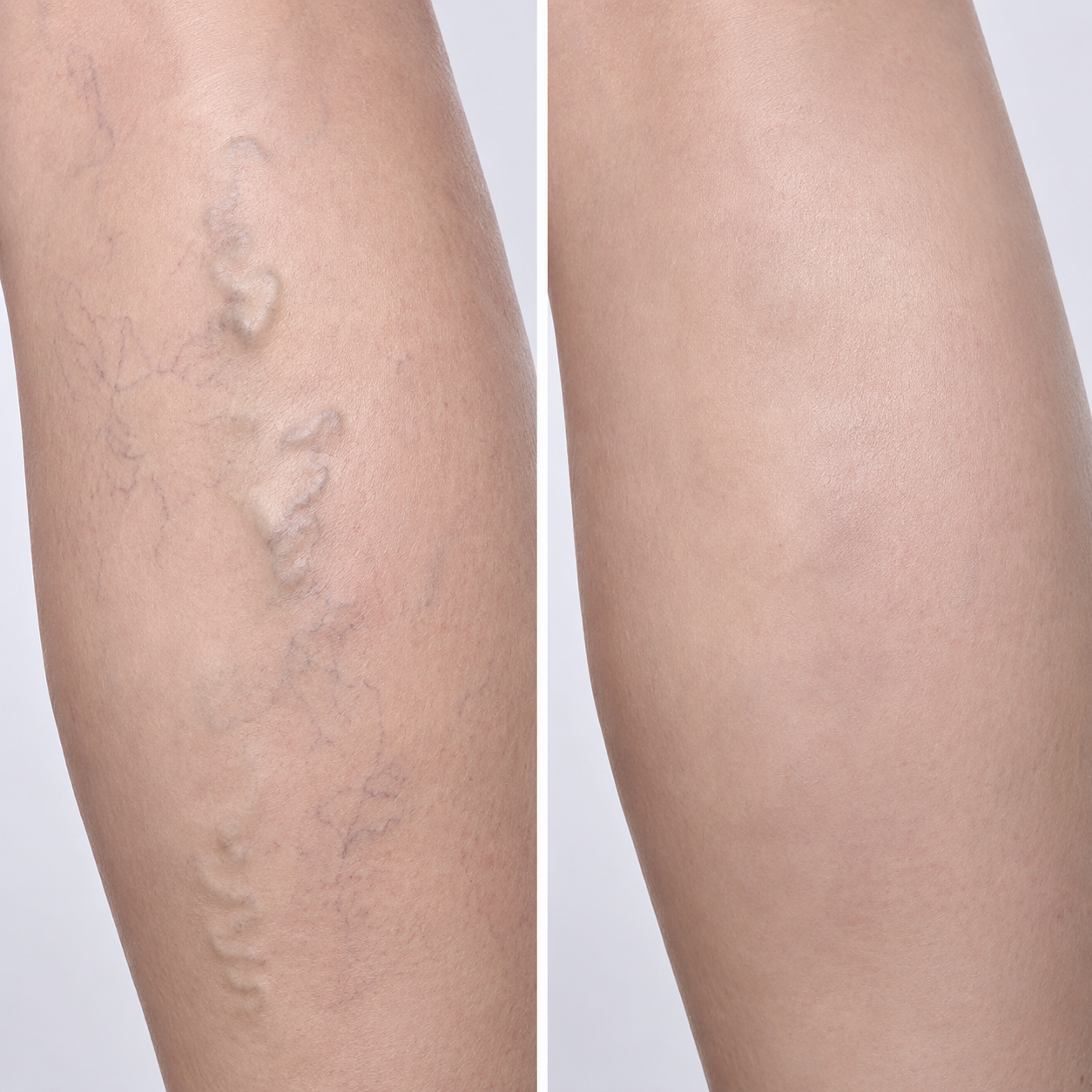 Varices/Veines visibles