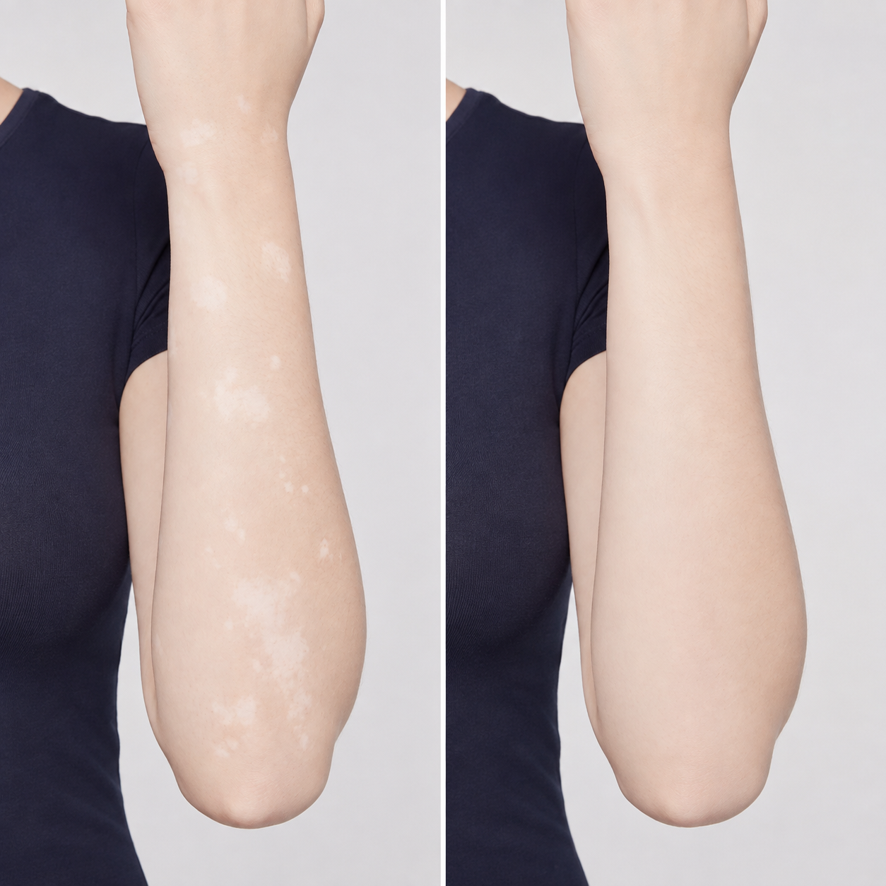 Vitiligo